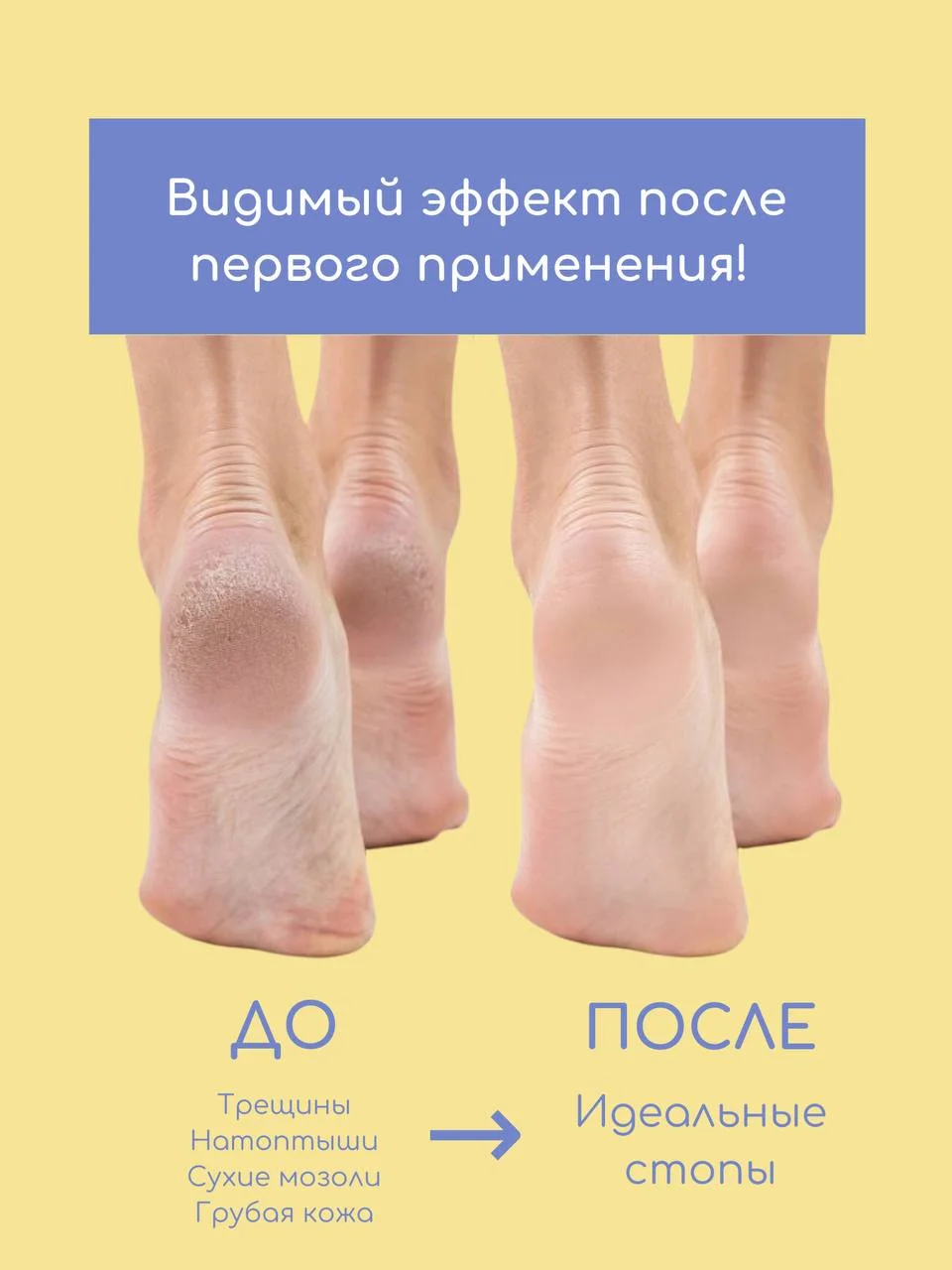 SKINTERRIA Средство для педикюра от мозолей и натоптышей Кератолитик c мочевиной 30% 250мл
