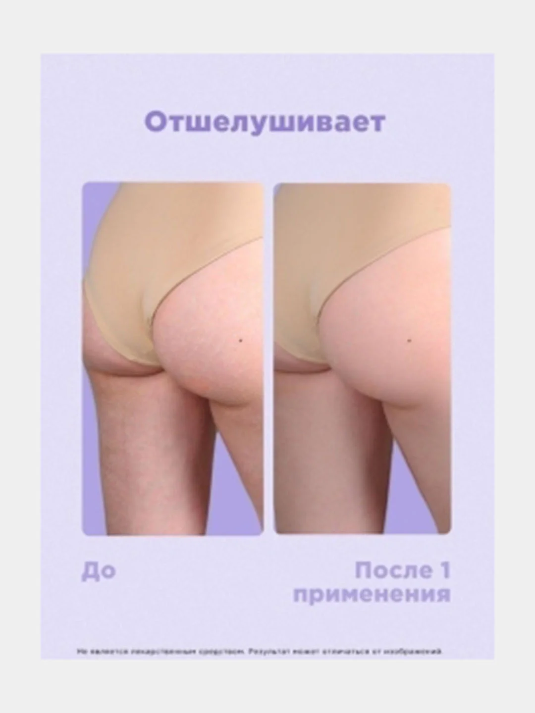 Антицеллюлитный комплекс