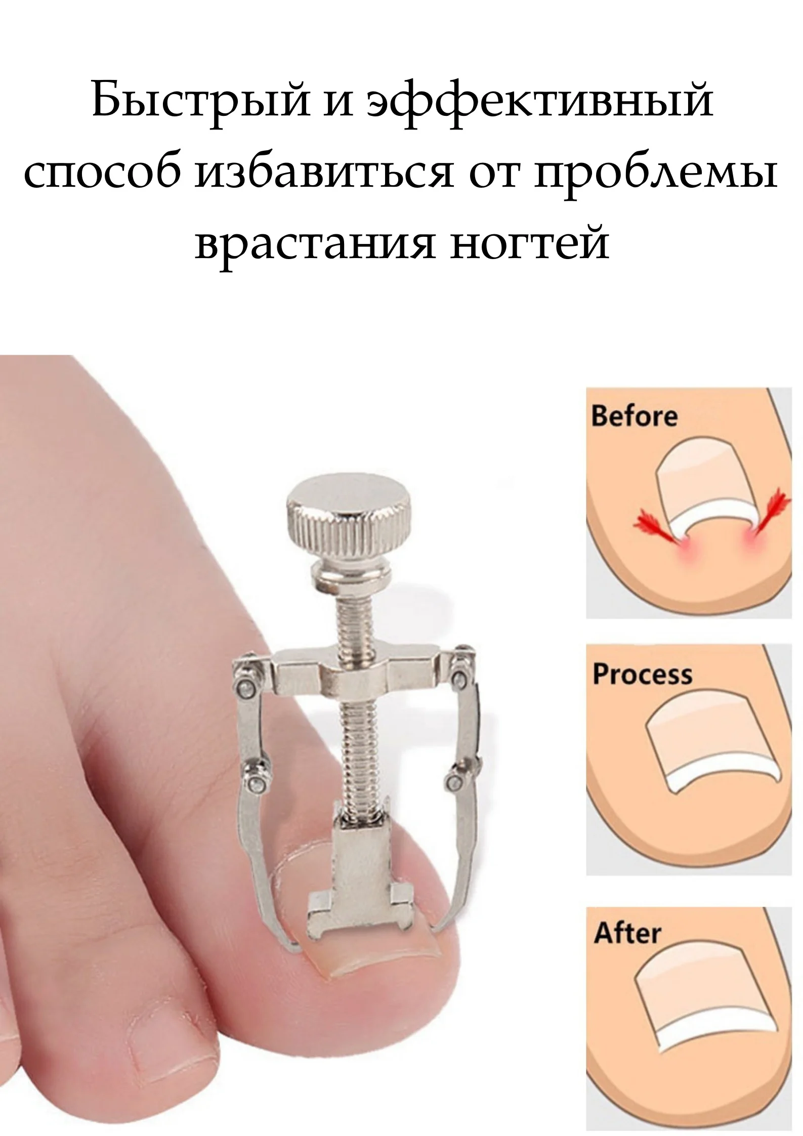 Инструмент для коррекции вросшего ногтя