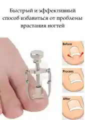 Инструмент для коррекции вросшего ногтя