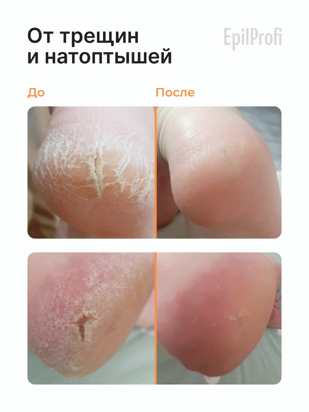 Набор для педикюра EpilProfi: гель и крем для ног с мочевиной, пемза в комплекте