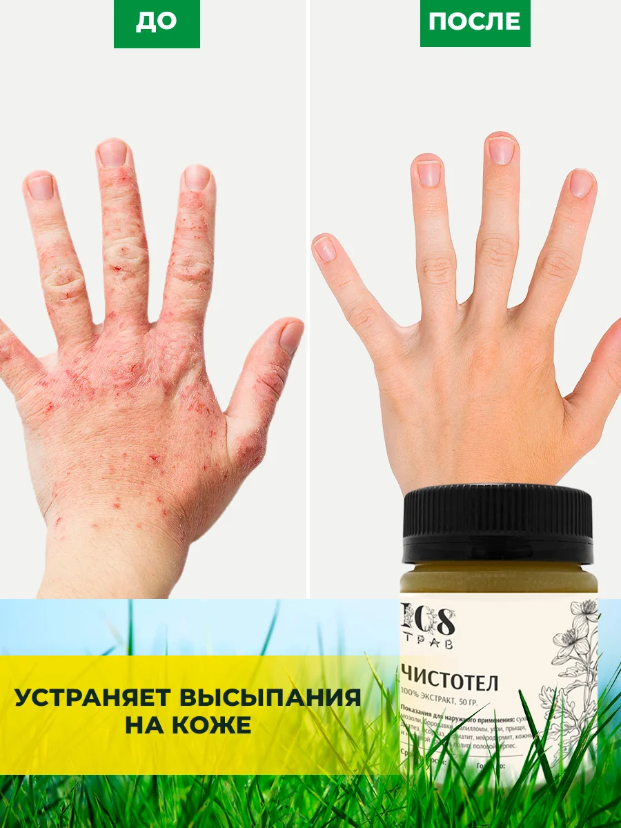 Мазь от прыщей "Чистотел" крем для проблемной кожи, сухой кожи / 108 трав, 50 г