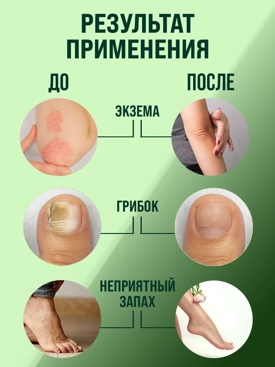 Мазь от псориаза, от грибка ногтей на ногах, мох сфагнум эмульсия / 108 трав, 100 г