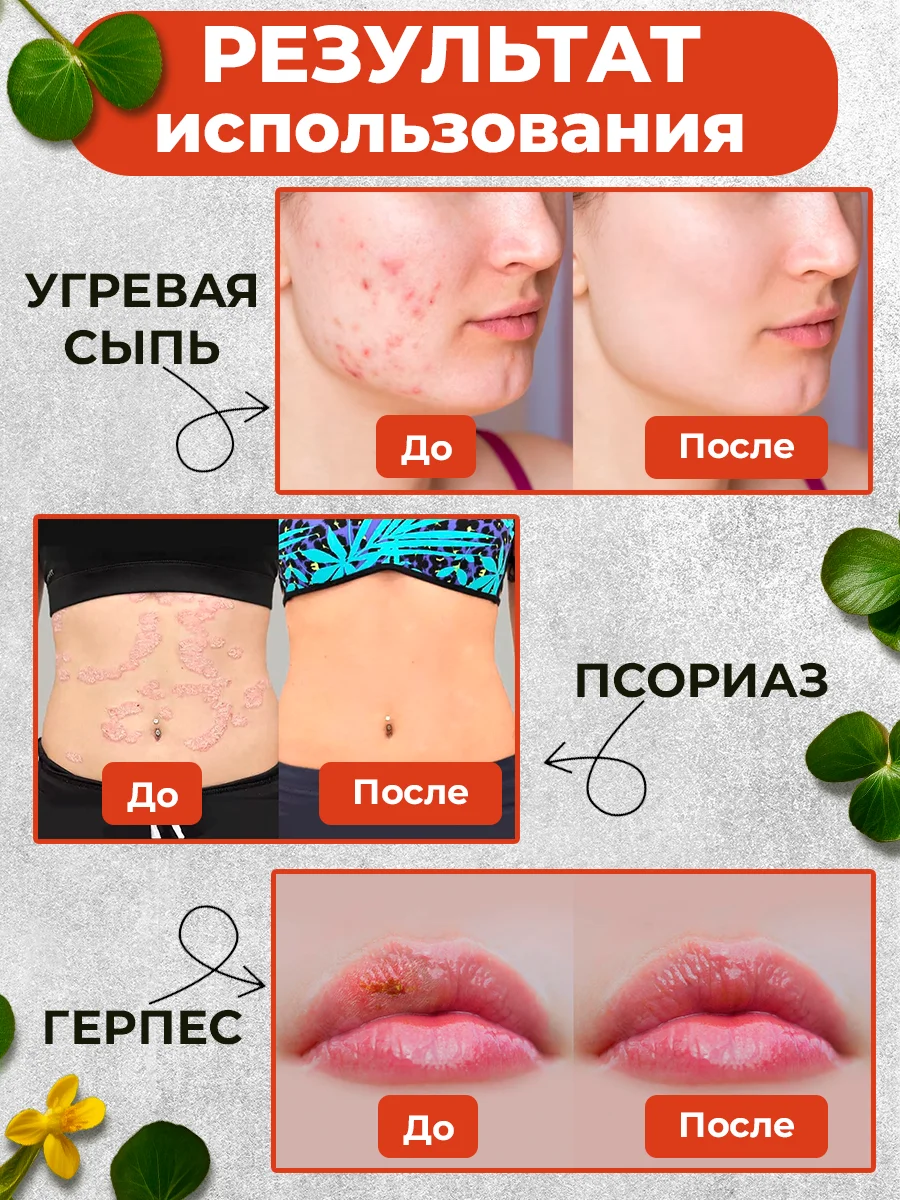 Крем-эмульсия от прыщей и угрей, 100% натуральный чистотел, 108 трав