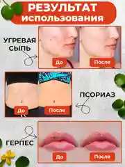 Крем-эмульсия от прыщей и угрей, 100% натуральный чистотел, 108 трав