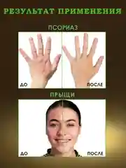 100% Экстракт ЧИСТОТЕЛ средство от мозолей, бородавок, прыщей,псориаза,грибка ногтей 50гр