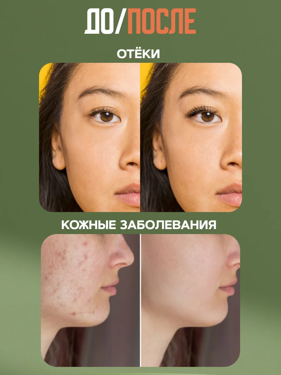 Экстракт "Живица кедра" отложение солей, отёчность ног, трофические язвы, 100 г, воск