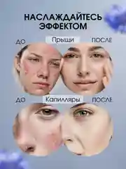 Крем от прыщей "Василёк" от угрей, капиллярной сеточки, перхоти, себореи, 100 г, воск