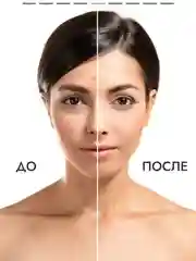 Сыворотка для лица SEMILY от акне, 30 мл