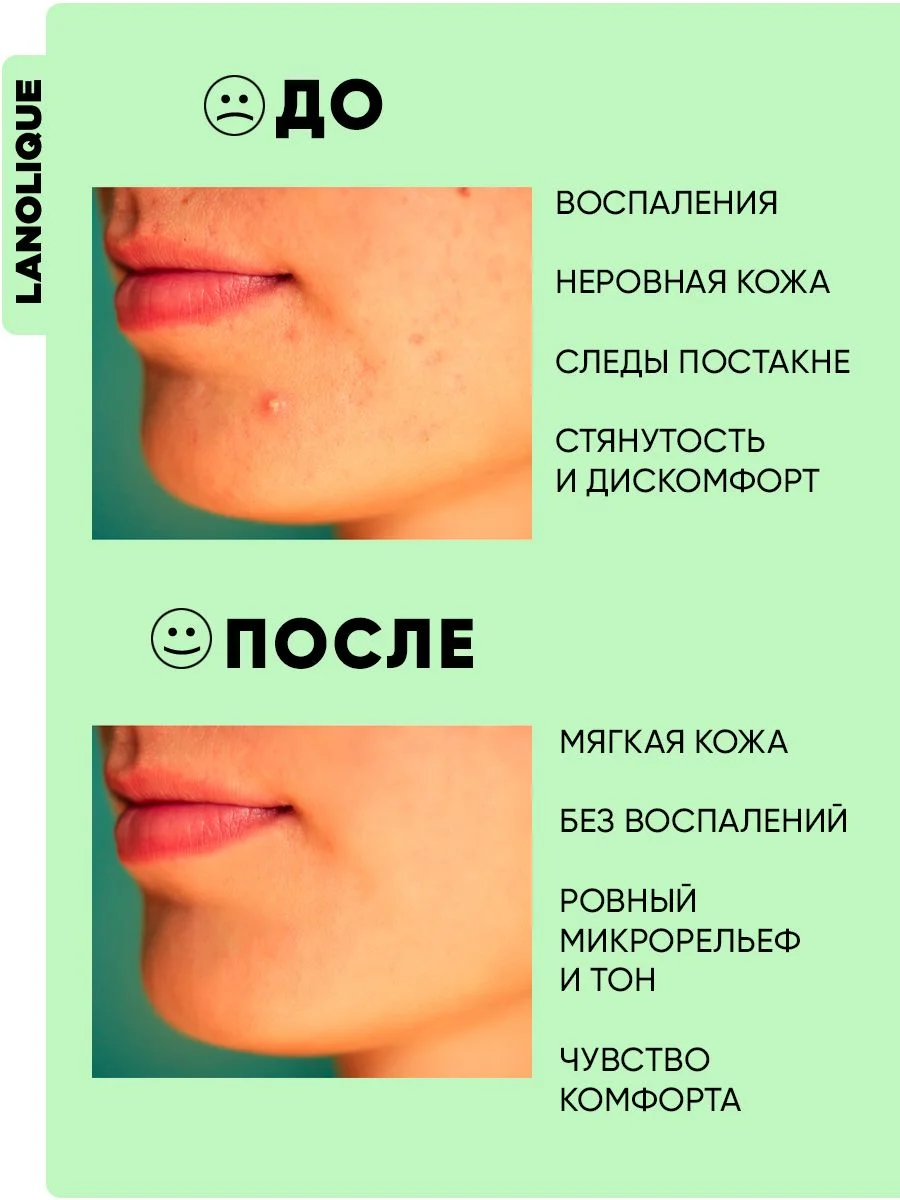Сыворотка пилинг для лица кислотный SEBO BALANCE, 30 мл