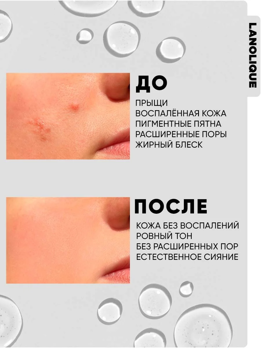 Сыворотка для лица от прыщей ANTI-ACNE HELPER, 30 мл