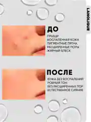 Сыворотка для лица от прыщей ANTI-ACNE HELPER, 30 мл