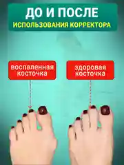 Вальгусный корректор для большого пальца, вальгусная шина для выпрямления косточки на ноге