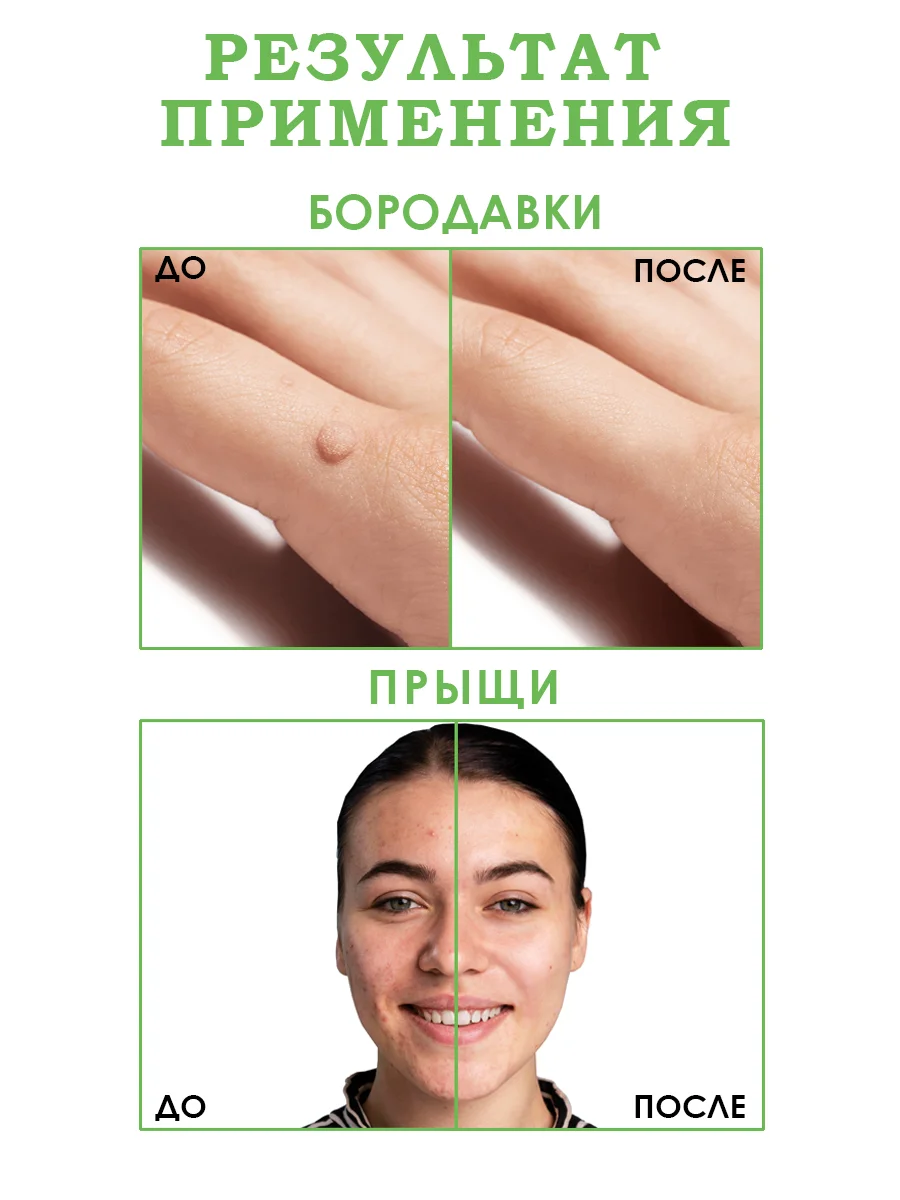 100% Экстракт Чистотел от папиллом,прыщей,угрей,бородавок,псориаз,сыворотка от прыщей/12гр