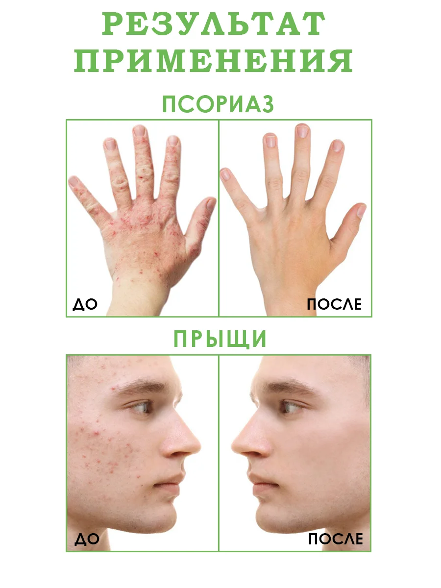 Экстракт чистотела от псориаза, от прыщей, грибка ногтей и кожи, бородавки/100г