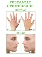 Экстракт чистотела от псориаза, от прыщей, грибка ногтей и кожи, бородавки/100г