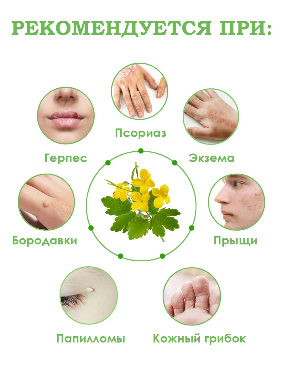 Экстракт чистотела от псориаза, от прыщей, грибка ногтей и кожи, бородавки/100г