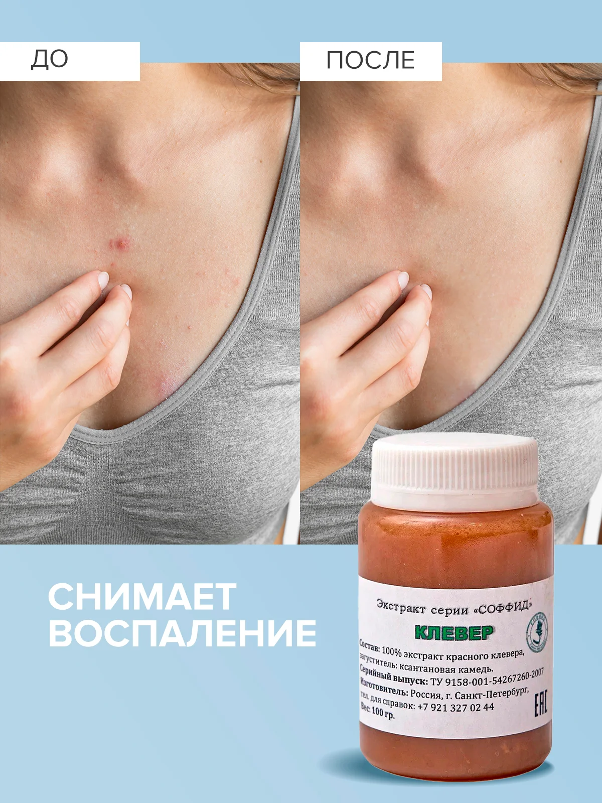 Крем для лица и тела с витаминами, от прыщей, от псориаза и дерматита/ Красный клевер, 100 г