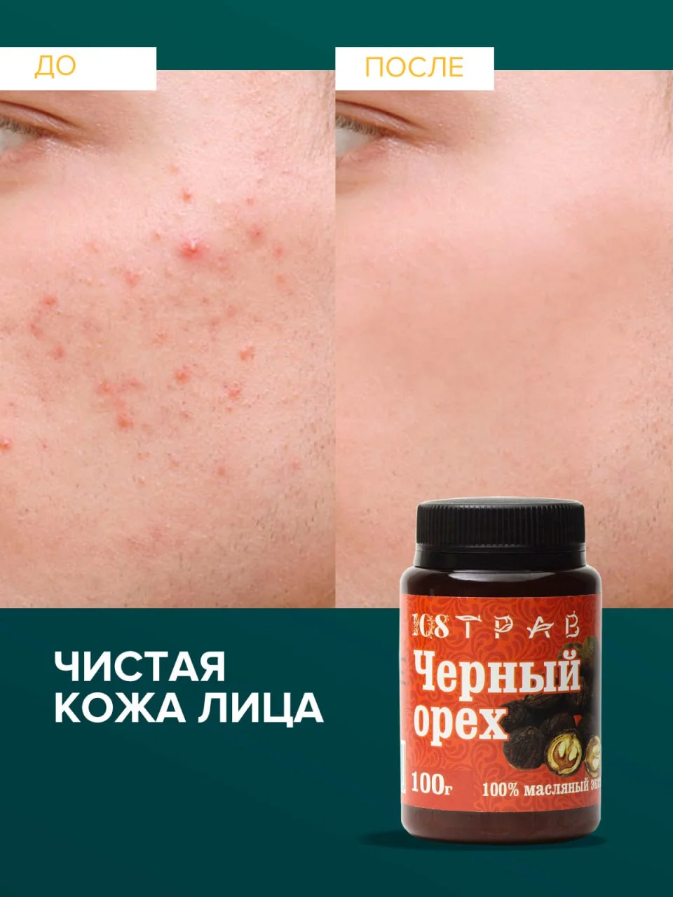 Крем-эмульсия черного ореха от псориаза, дерматита, экземы, мазь от геморроя, 108 трав, 100 г