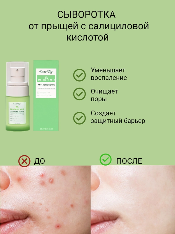 Эссенция для лица с салициловой кислотой, сыворотка анти-акне, от прыщей