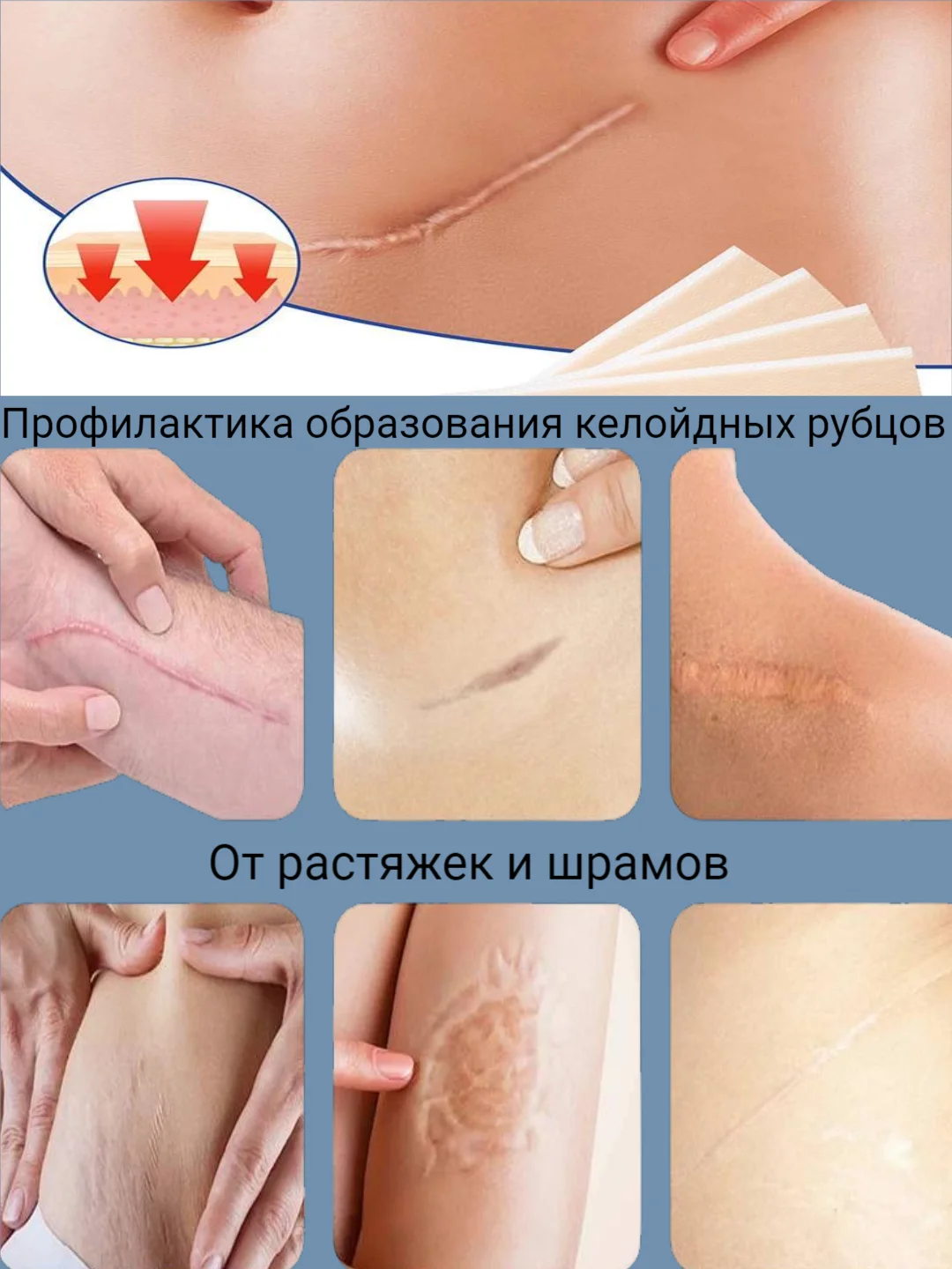 Бежевый пластырь силиконовый от шрамов и рубцов, пластырь профилактический