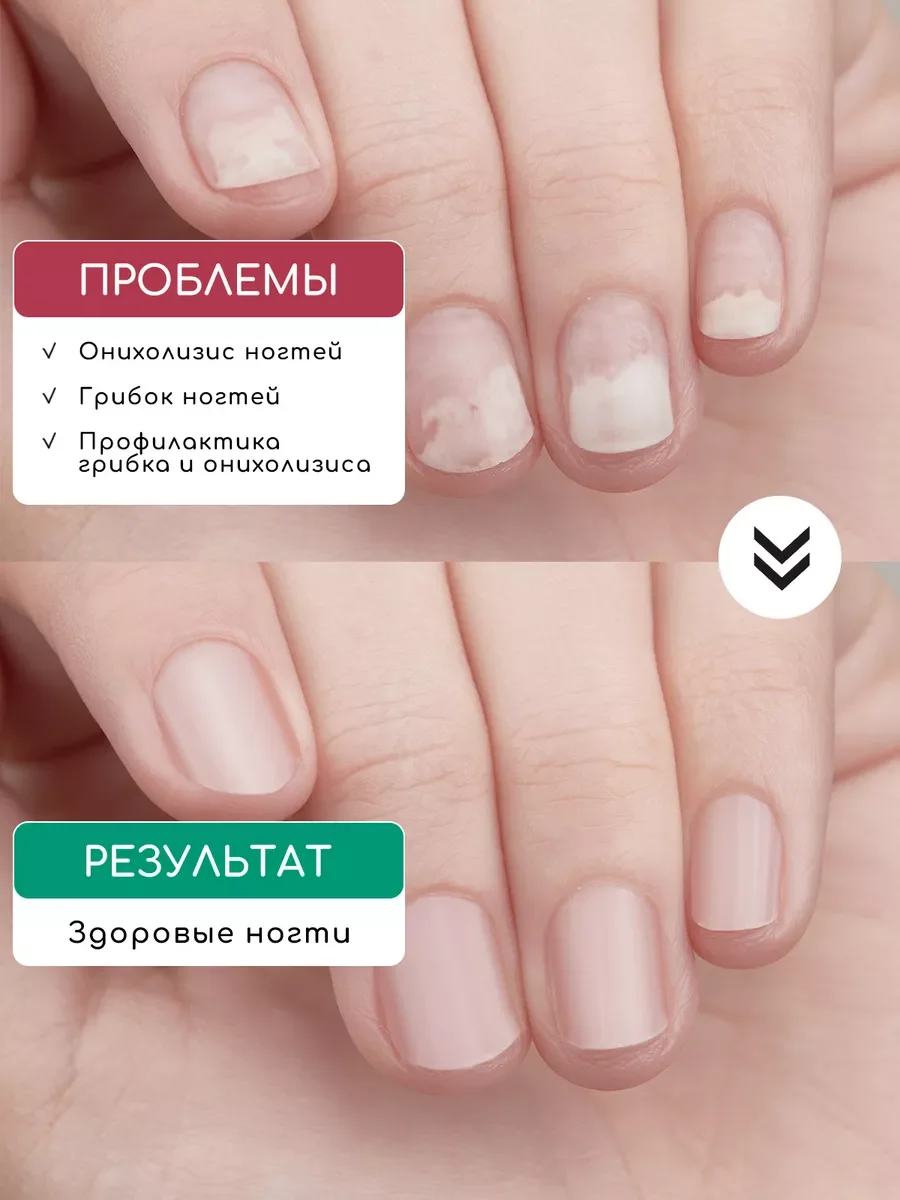 Набор лосьон для ногтей "Стоп онихолизис" против отслоения, 1+1