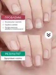 Набор лосьон для ногтей "Стоп онихолизис" против отслоения, 1+1
