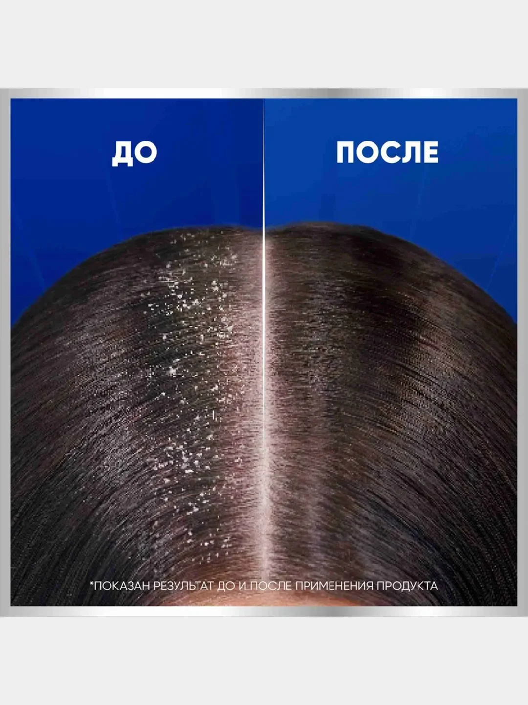 Шампунь Head&Shoulders Снятие сильного зуда, 7 в 1, 300 мл