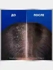 Шампунь Head&Shoulders Снятие сильного зуда, 7 в 1, 300 мл