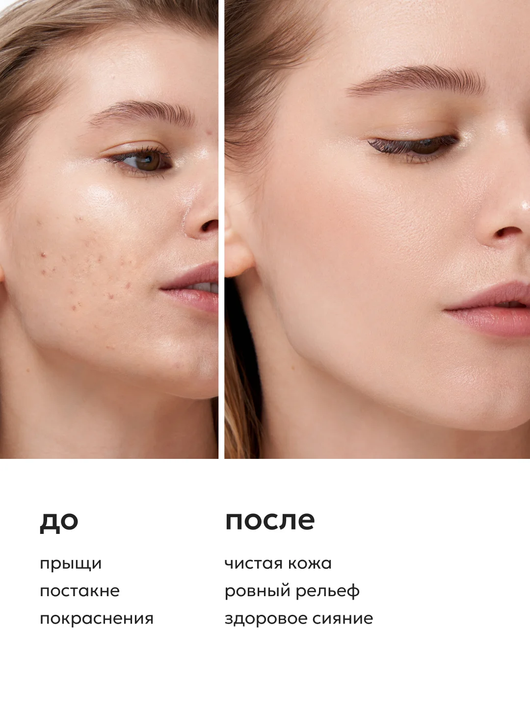 Likato Professional Лосьон-спрей от прыщей для лица и тела, 200 мл