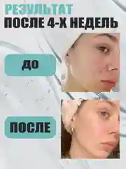 Гель для умывания от прыщей, акне и черных точек STOP ACNE, 150 мл