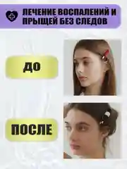 Точечный гель аппликатор от прыщей и акне STOP ACNE, 30 мл