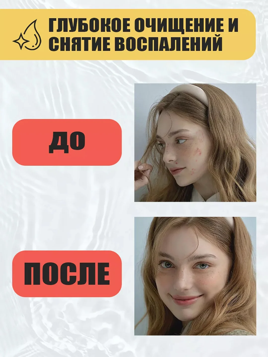 Тоник для лица от прыщей, акне и черных точек STOP ACNE, 150 мл