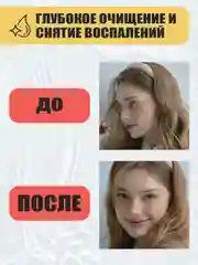Тоник для лица от прыщей, акне и черных точек STOP ACNE, 150 мл