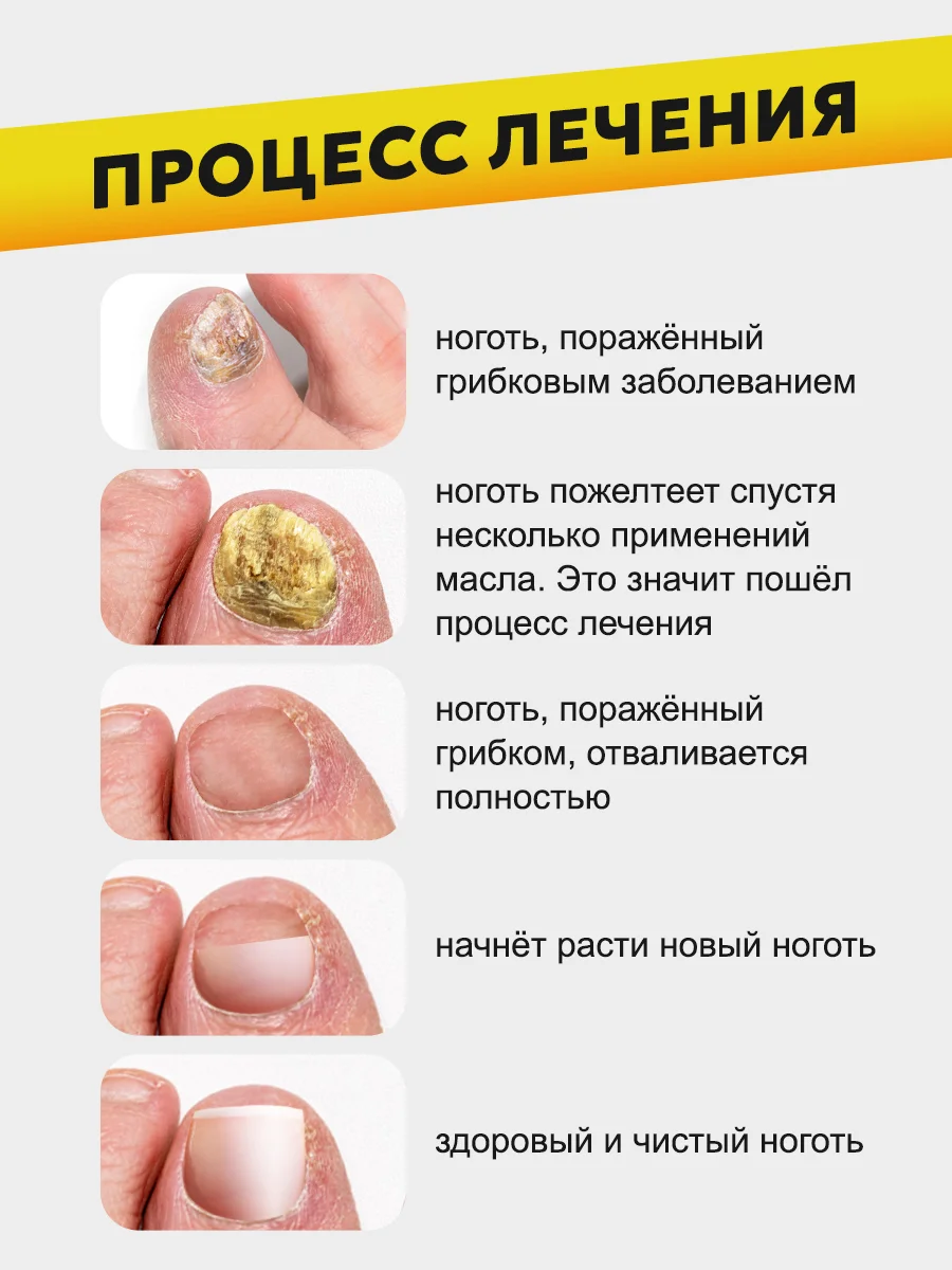 Желтый масло для ногтей от грибка, стоп онихолизис, 5 мл