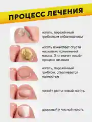 Желтый масло для ногтей от грибка, стоп онихолизис, 5 мл