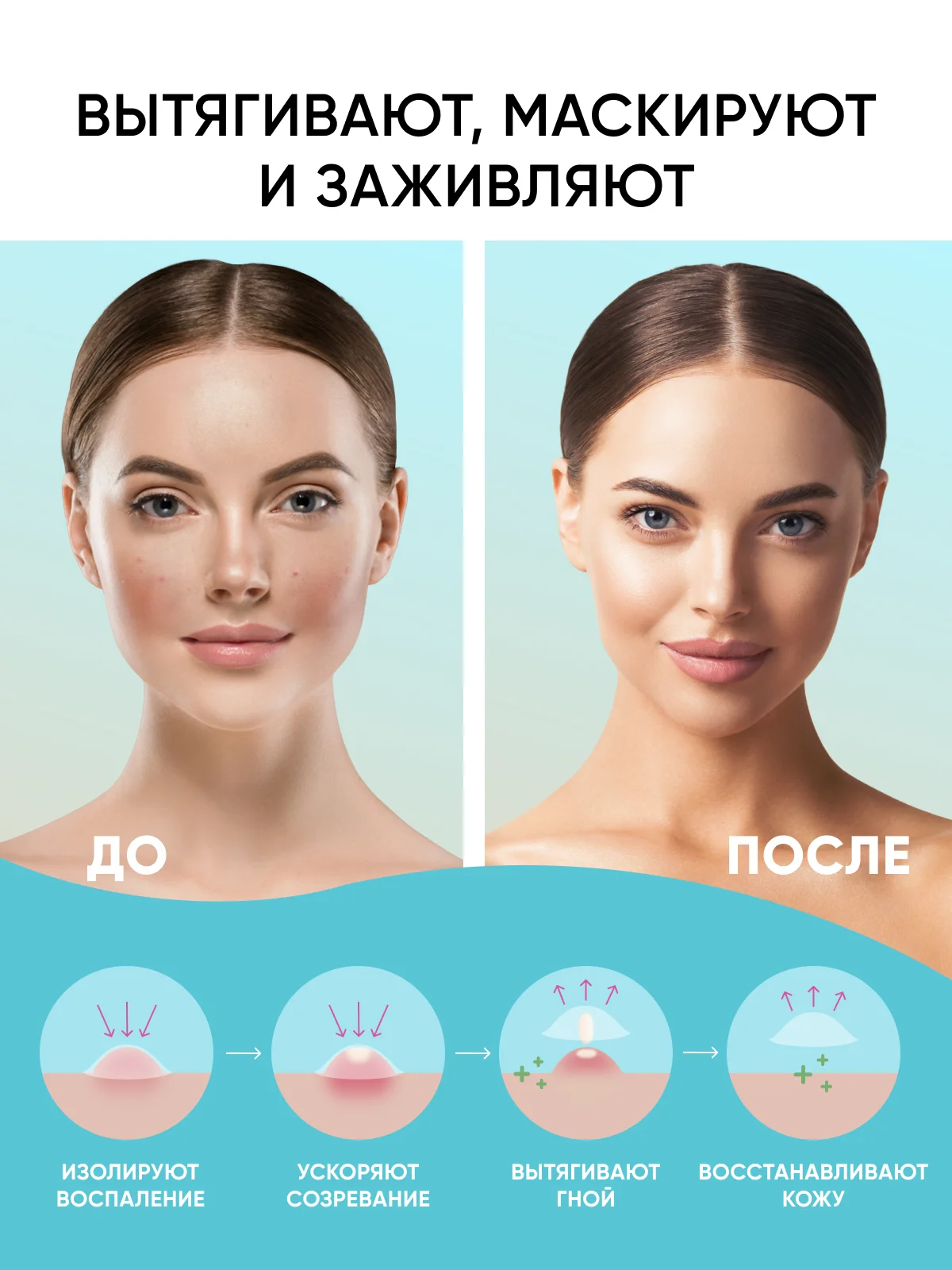 Патчи от прыщей 144 шт салициловая кислота и масло чайного дерева