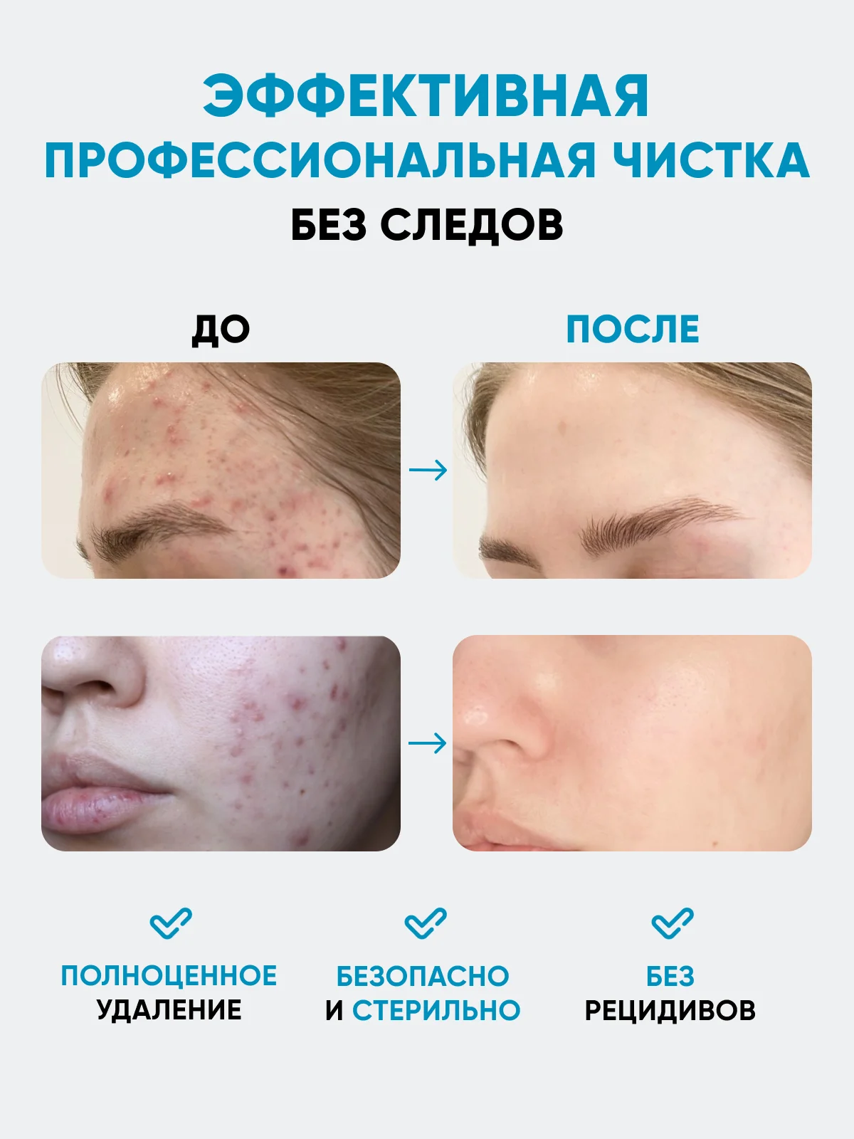 Набор для чистки лица инструмент от прыщей и черных точек