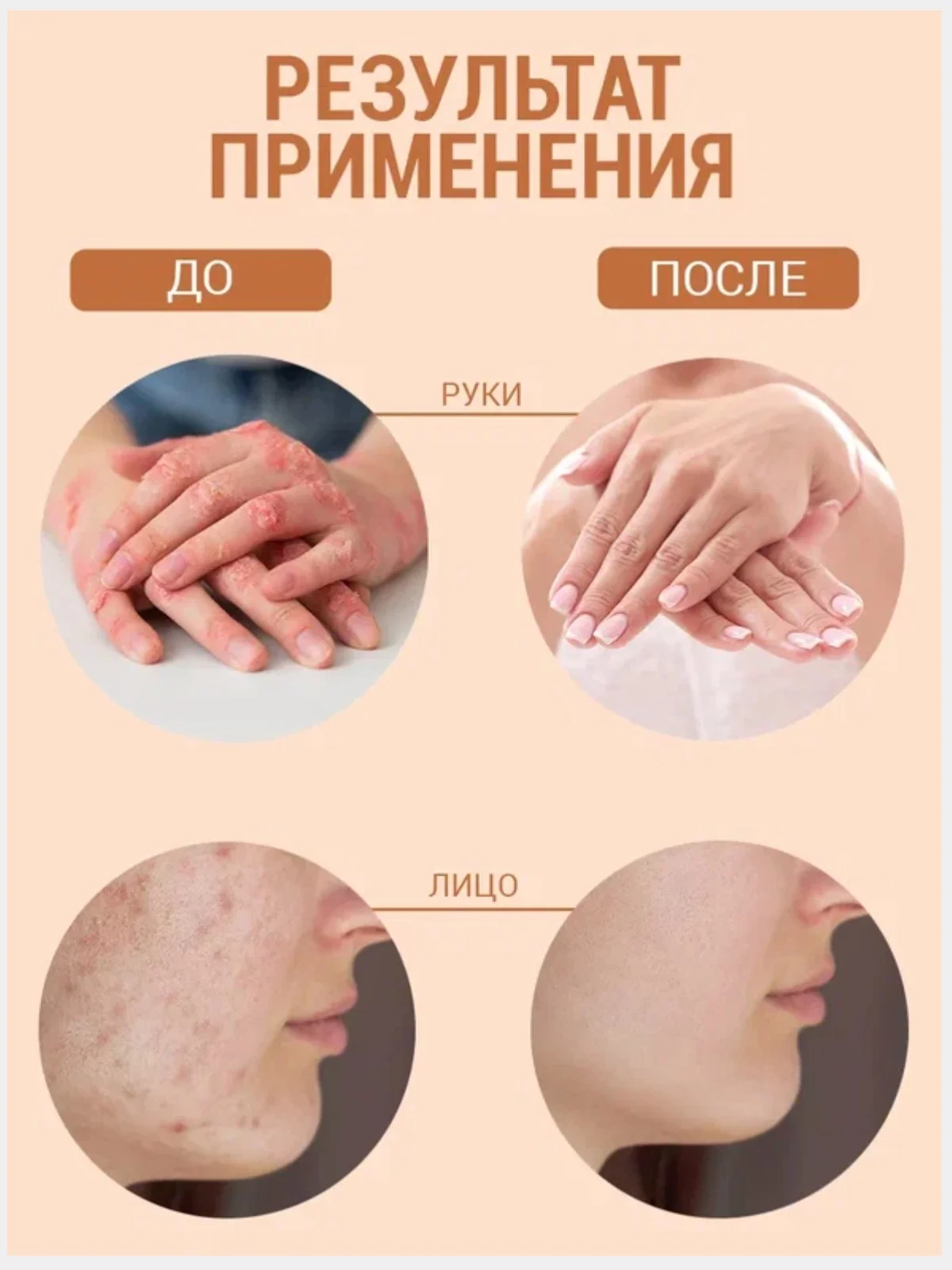 Живое мыло "Чистотел" от прыщей, угрей при псориазе, дерматите