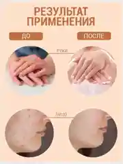 Живое мыло "Чистотел" от прыщей, угрей при псориазе, дерматите