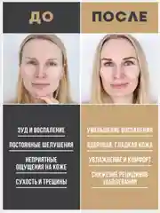 Крем от псориаза при кожных заболеваниях - при грибке кожи, экземе, дерматите - 50 мл